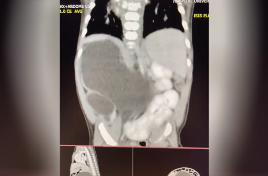 Caso raro: bebê nasce com quatro rins em Goiás