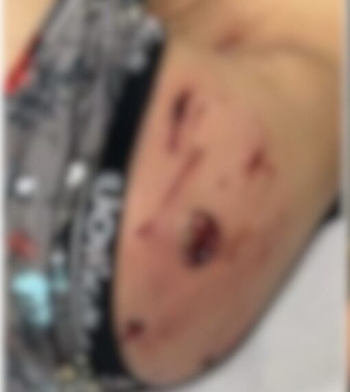 Criança tenta pegar pipa no quintal do vizinho e é atacada por pit bull